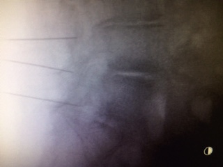 Información General Dolor Lumbar